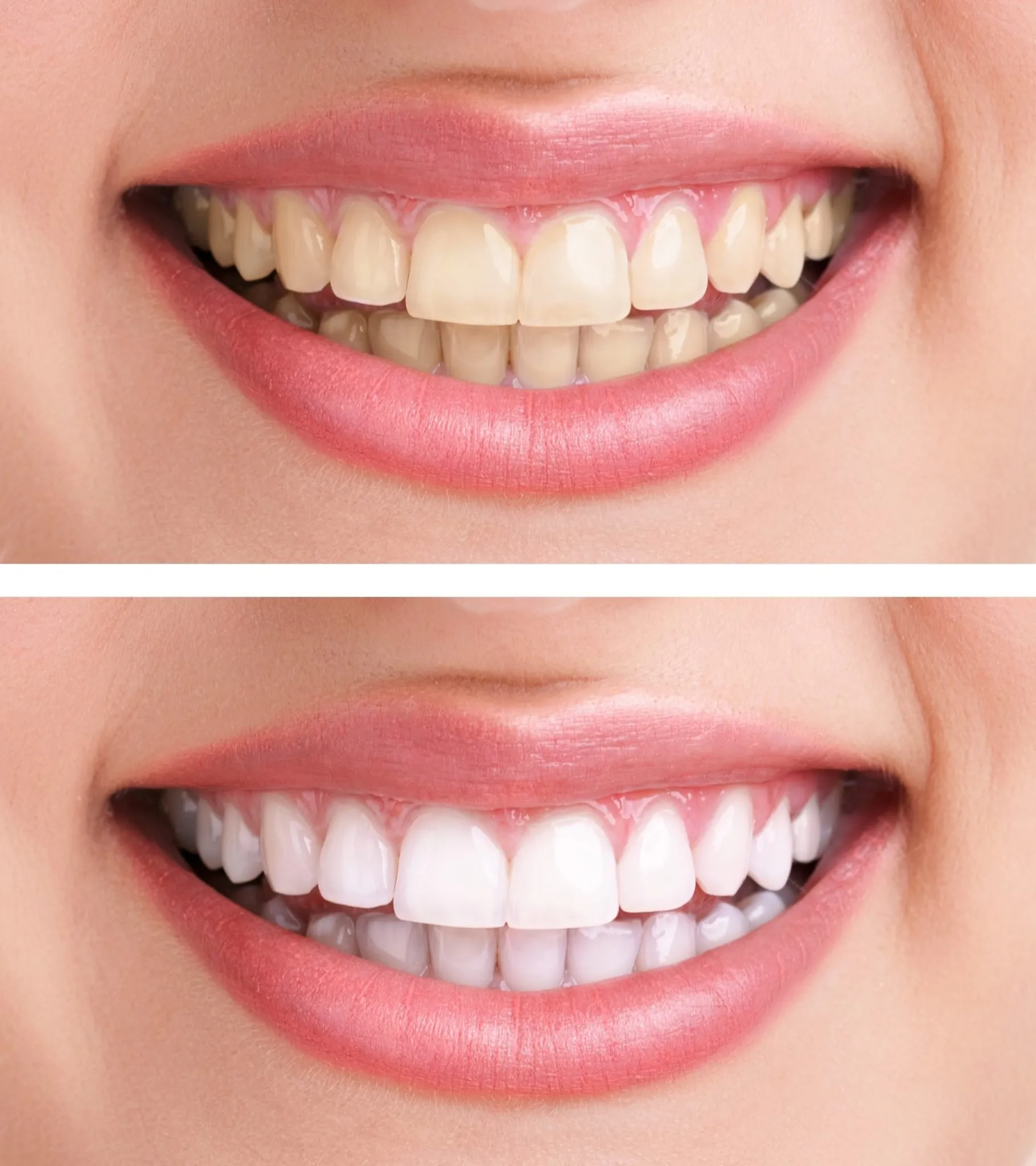 32377 at home teeth bleaching
