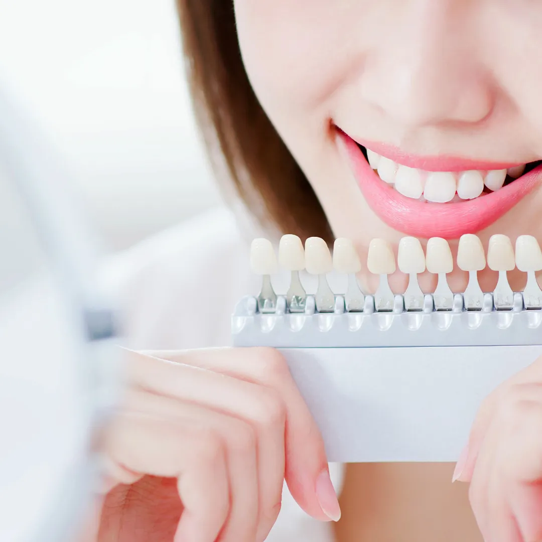 32377 over the counter teeth whitening