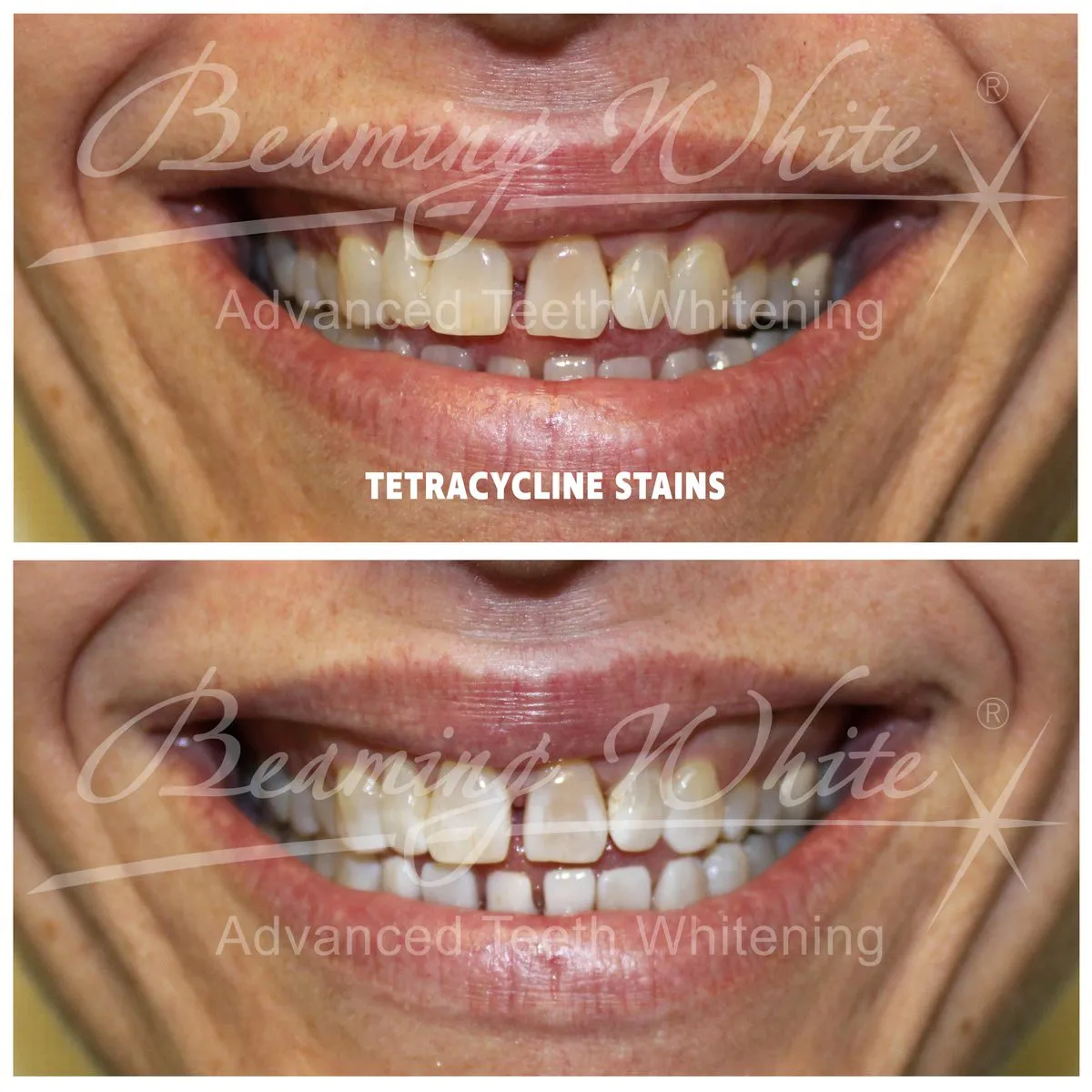 32380 baking soda teeth whitening