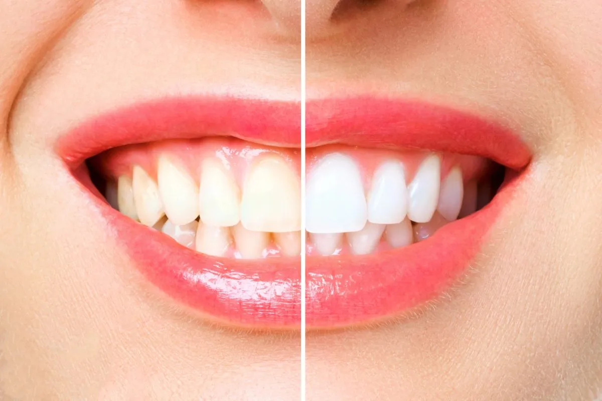 32380 natural teeth whitening header