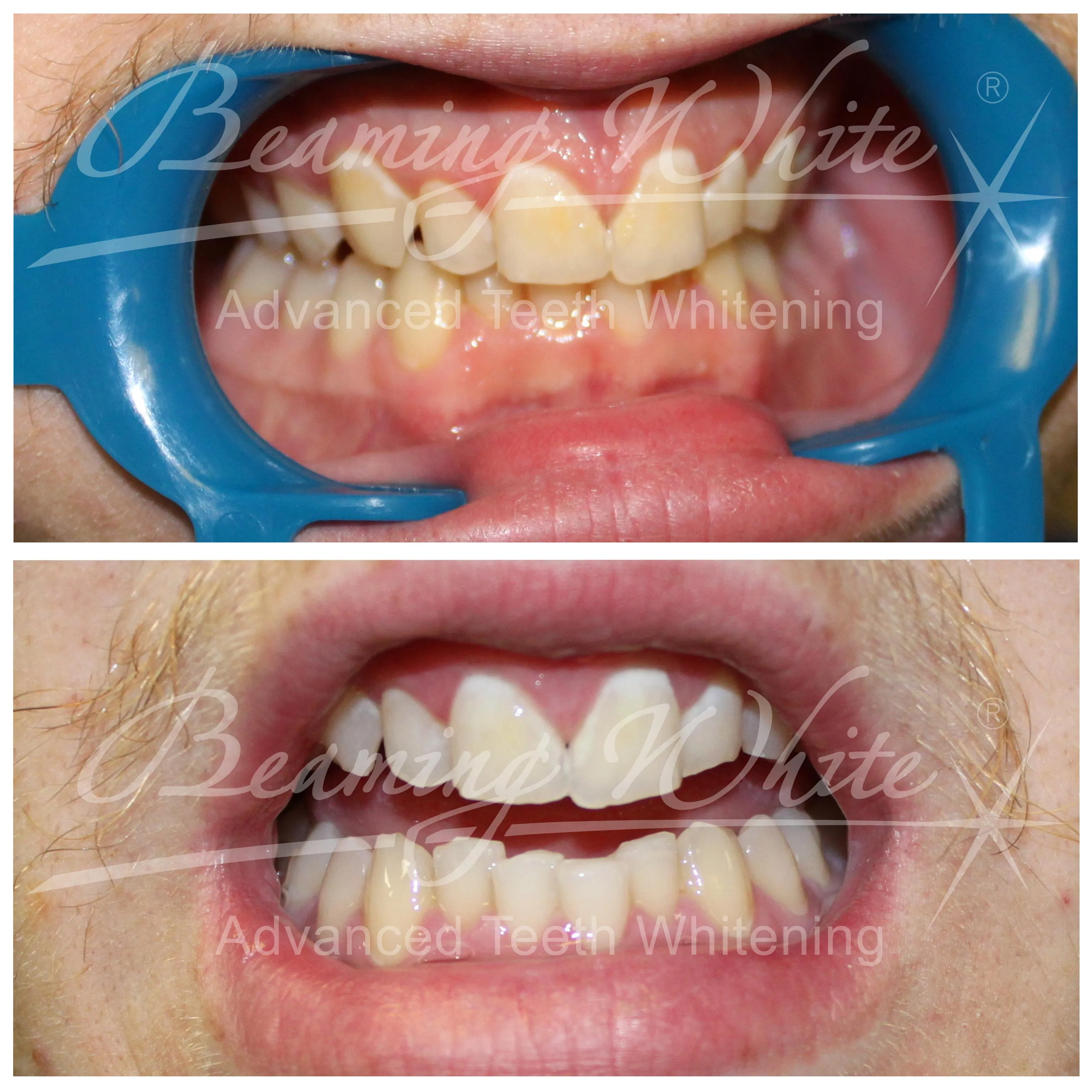 32380 oil pulling