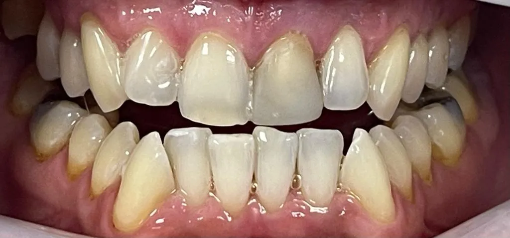 32382 sensitive teeth