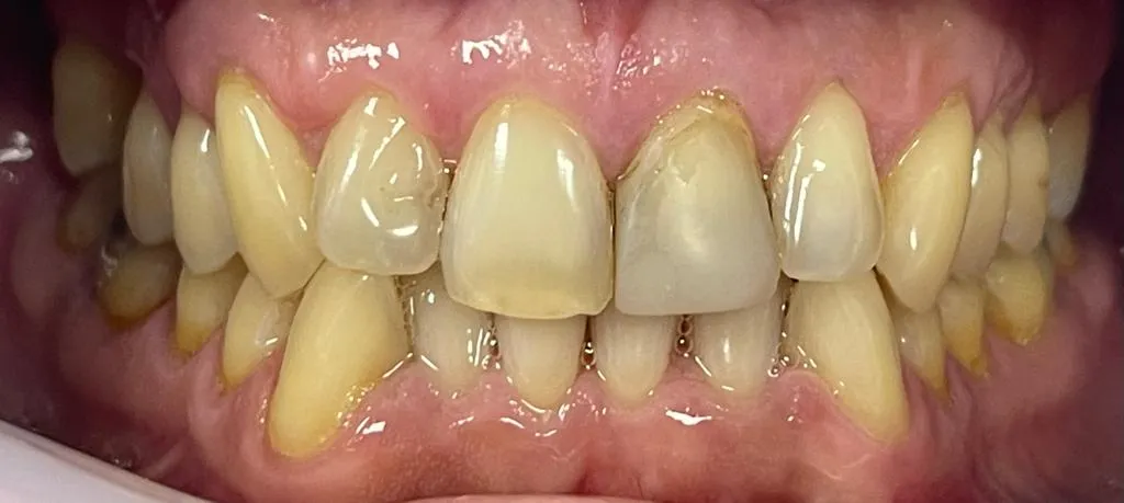 32382 zoom whitening process