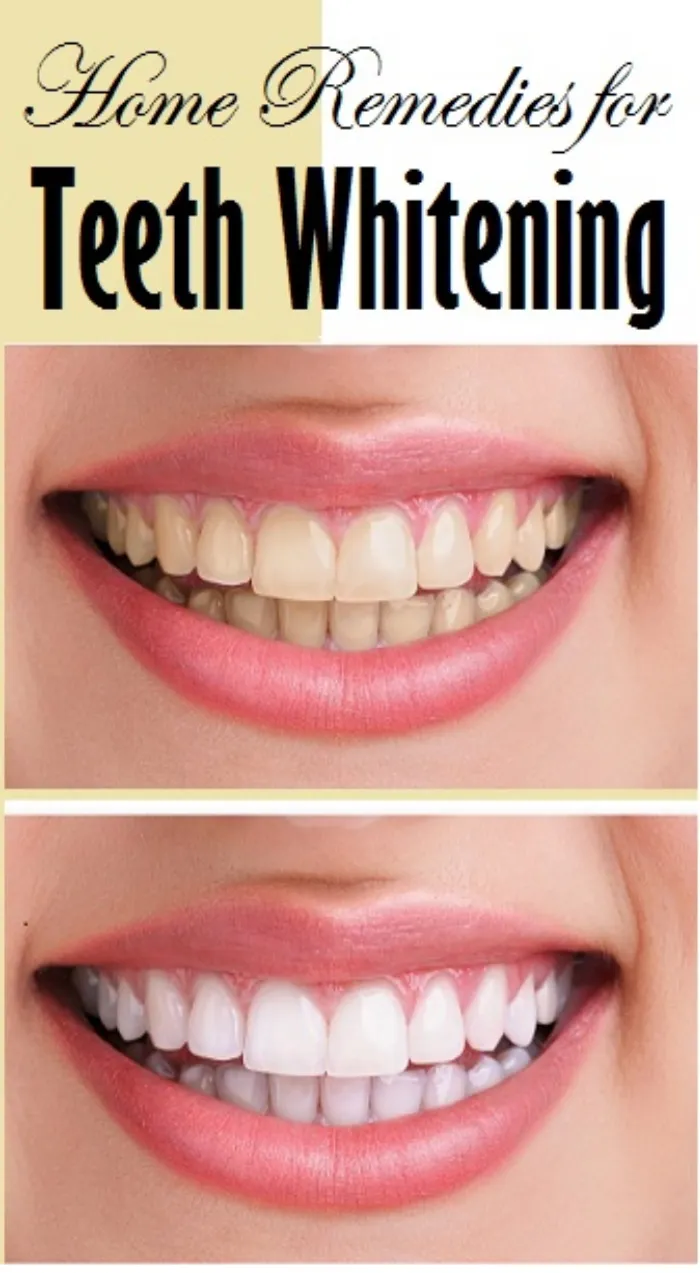 32383 baking soda teeth whitening