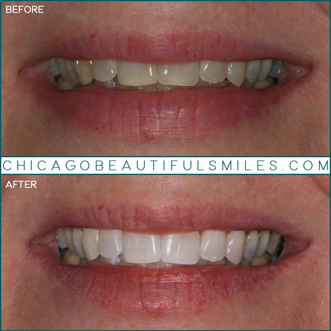 32384 enamel erosion image3