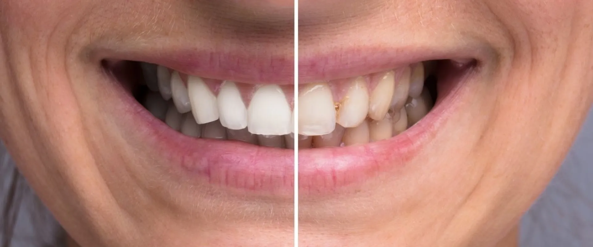 /img/32384-teeth-whitening-products-image7.webp