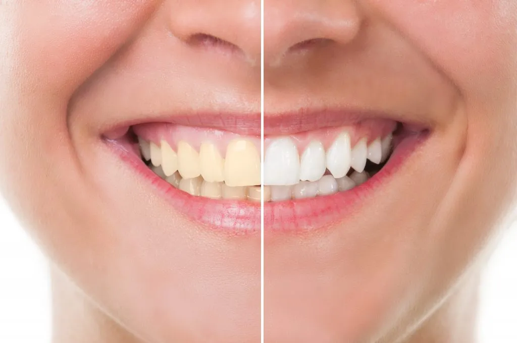 32384 uneven whitening image5