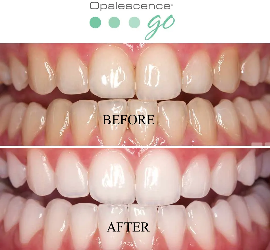32385 opalescence professional at home
