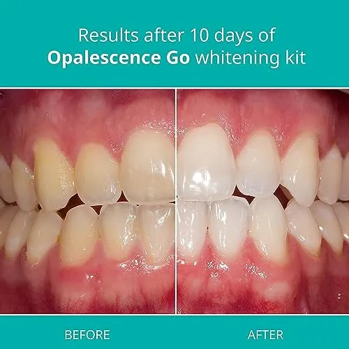 /img/32385-opalescence-tray-cleaning.webp
