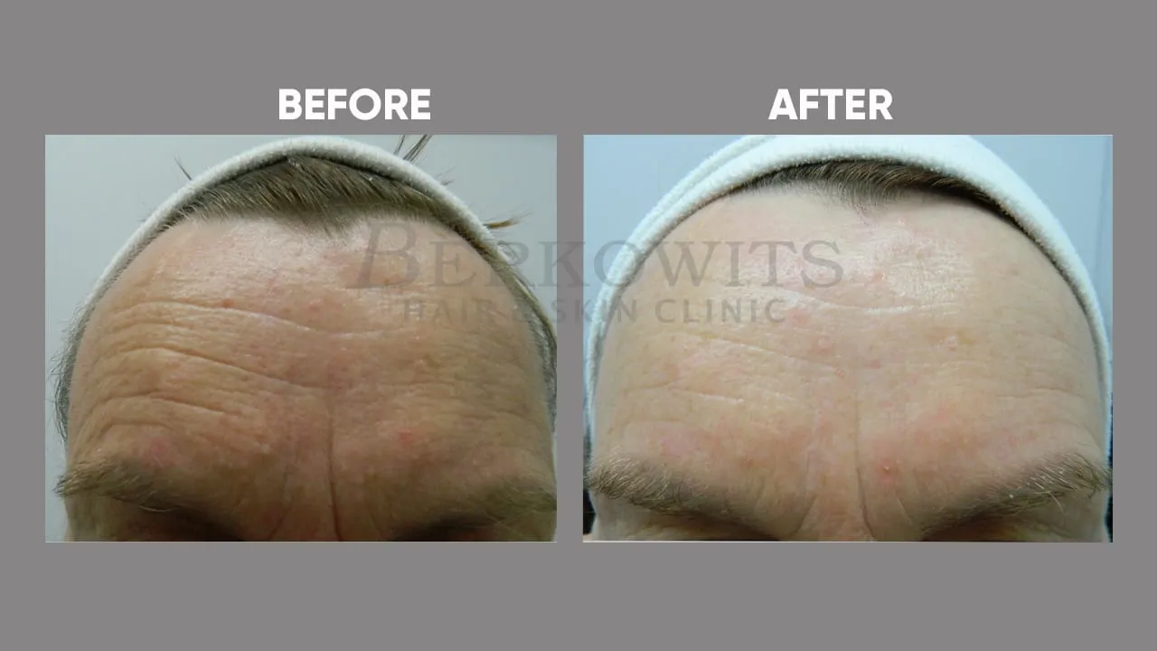 32387 mesotherapy skin whitening consultation